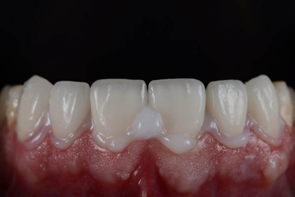 Dental Bonding Can Help With Chipped Teeth