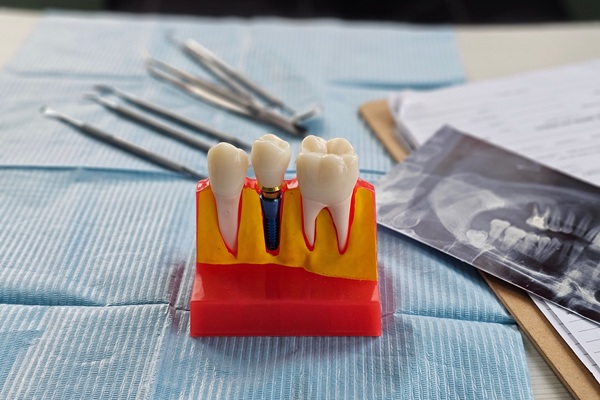 Root Canal Aftercare: Tips For A Smooth Recovery